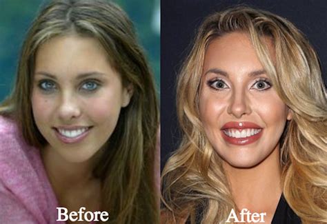 [PICS] Chloe Lattanzi’s Plastic Surgery Before & After Pics 